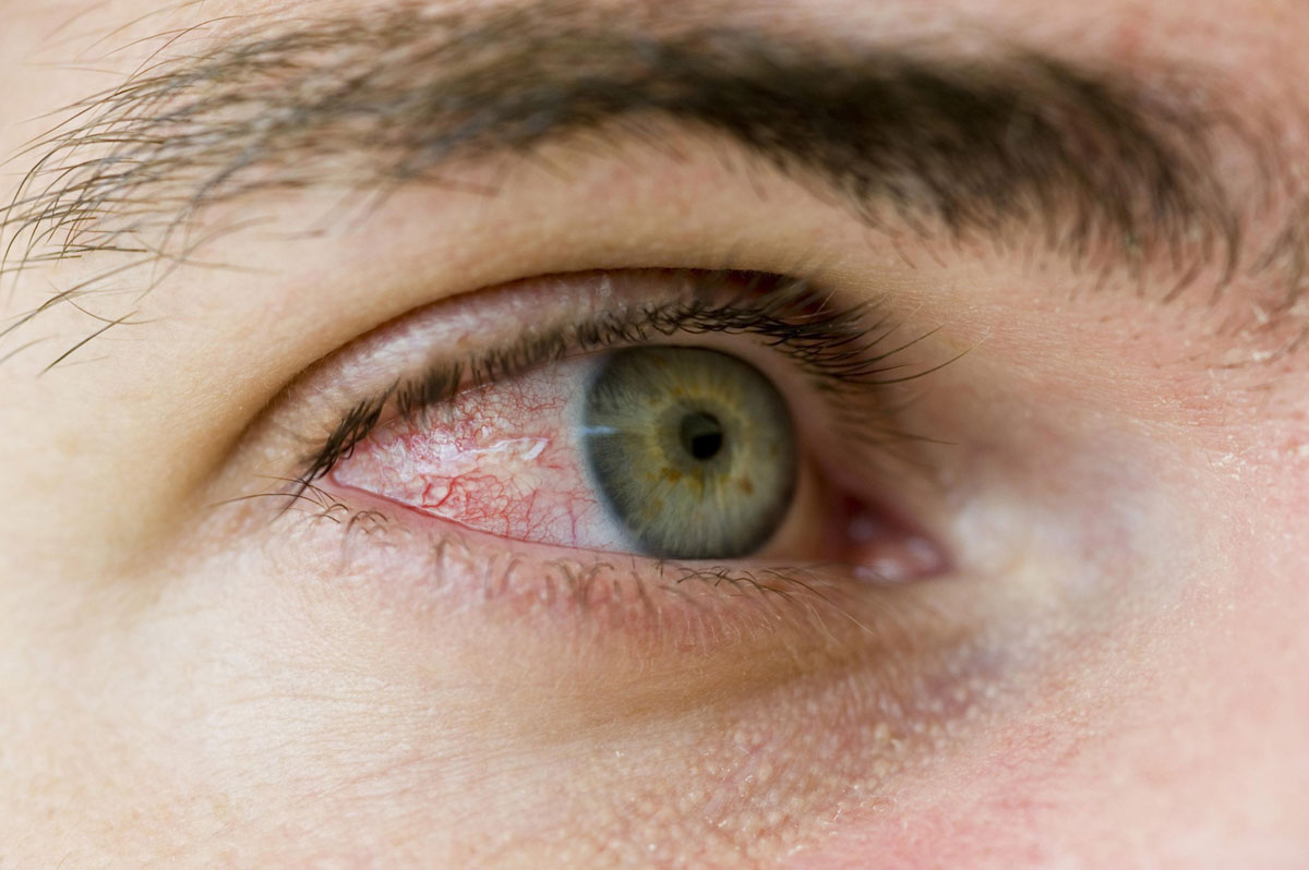 Yeux Rouges, Attention, Vous êtes Peut-être Allergique Au Pollen